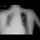 Pneumothorax, supine radiograph: X-ray - Plain radiograph